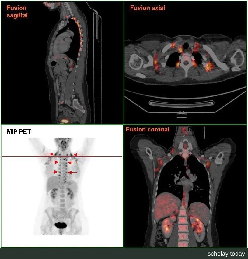 一例 FDG PET/CT:受检者检查时受冷,颈部、锁骨上和脊柱旁的棕色脂肪摄取葡萄糖而显影(箭头处)。此图并非本文所述论文的图片